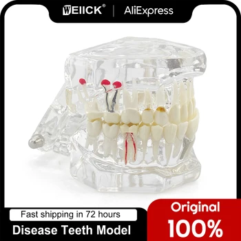 Модель заболеваний зубов с реставрационным мостовидным протезом, Стоматолог для медицинских исследований, обучение стоматологическим заболеваниям, Зубной имплантат